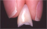 左右の歯に合わせた歯色の調整も大切