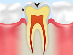 C1 ～エナメル質の虫歯～