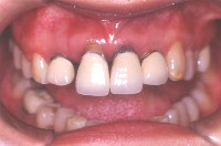 歯周病に冒された前歯の治療例